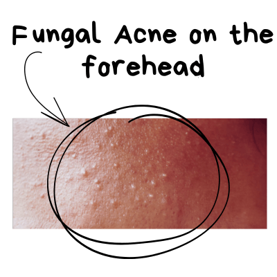 Image showing fungal acne on forehead
